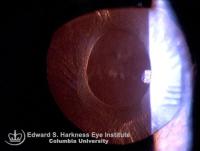 Small diameter anterior capsulorhexis